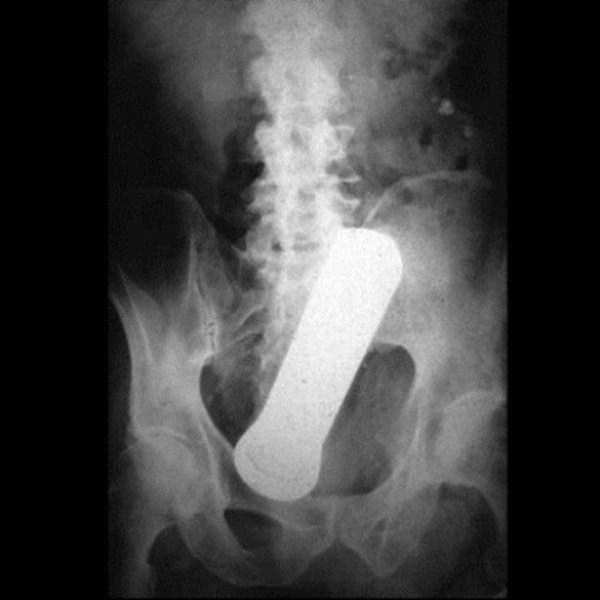 Bizarre Objects Found in Peoples Butts (27 photos)