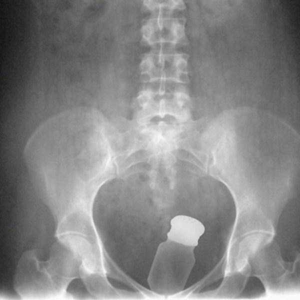 Bizarre Objects Found in Peoples Butts (27 photos)