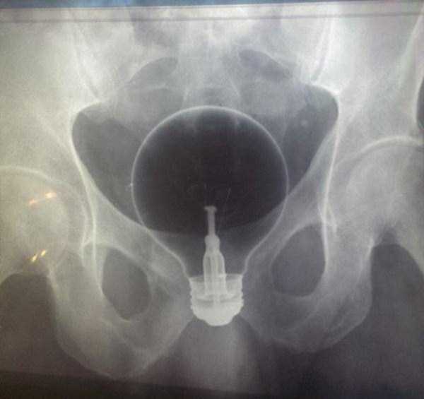 Bizarre Objects Found in Peoples Butts (27 photos)