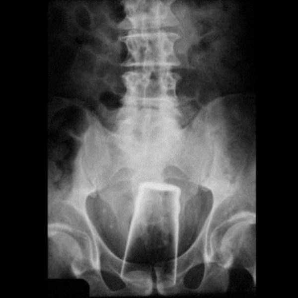 Bizarre Objects Found in Peoples Butts (27 photos)