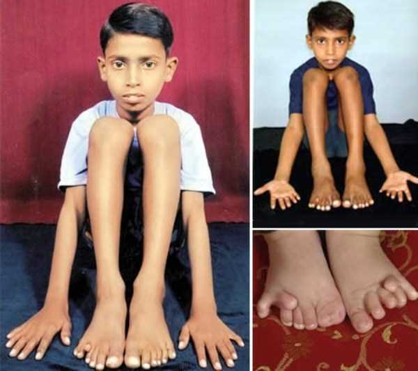 Bizarre Looking Human Hands and Feet (30 photos)