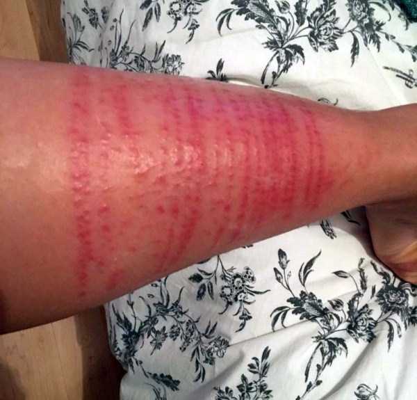 The Skin After Contact With Jellyfish (9 photos)