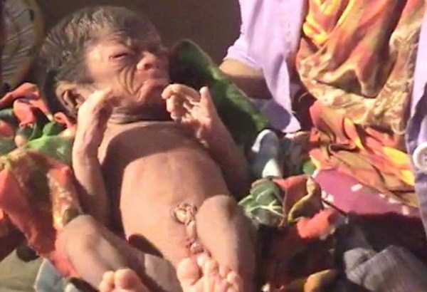 bangladeshi baby with progeria 1