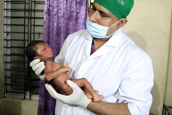 bangladeshi baby with progeria 2