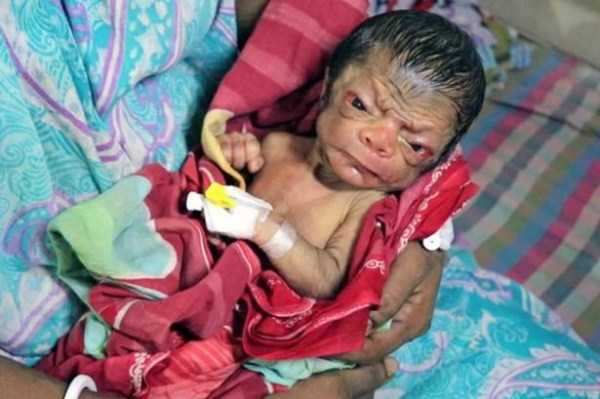 bangladeshi baby with progeria 3