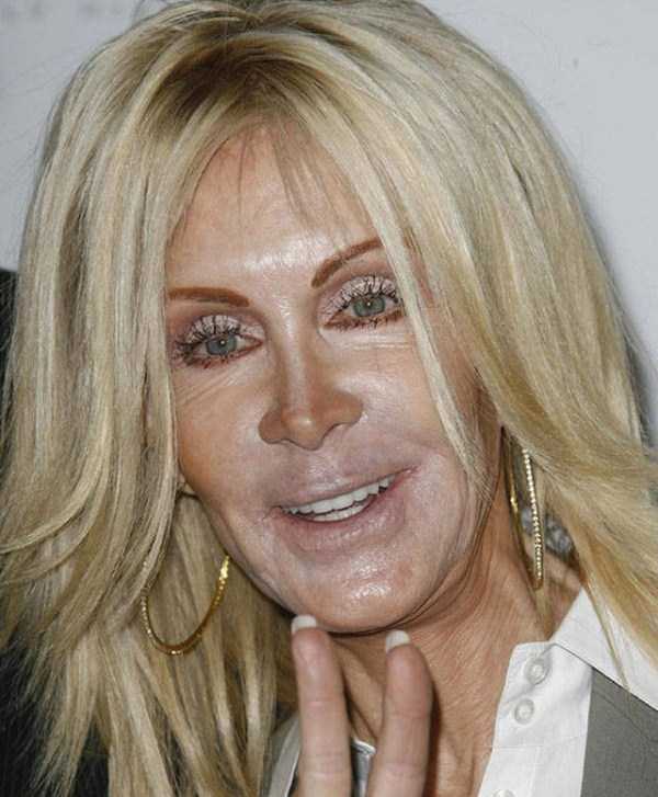 plastic surgery disasters 17