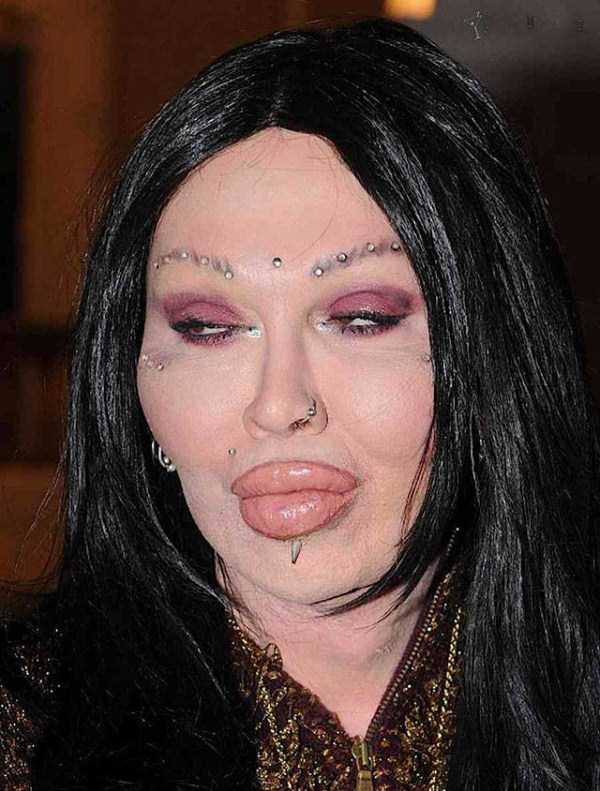 plastic surgery disasters 18