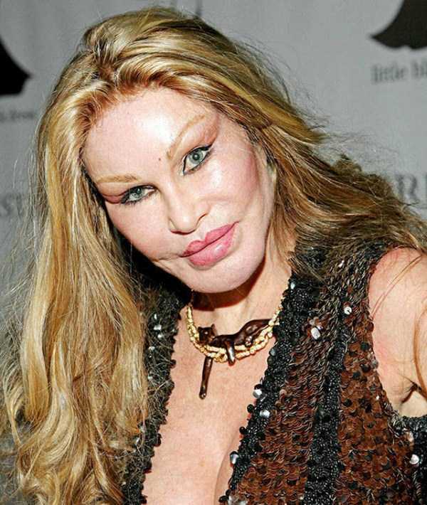 plastic surgery disasters 19