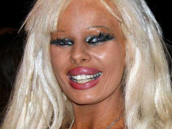 plastic surgery disasters 28