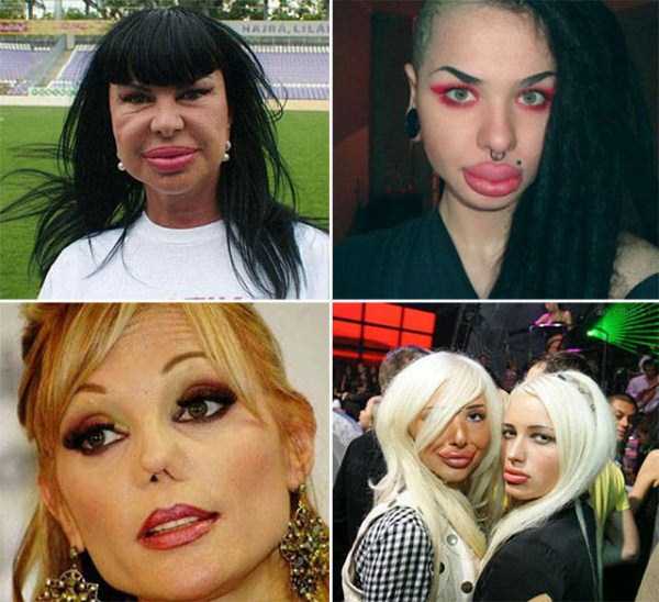 plastic surgery disasters 31