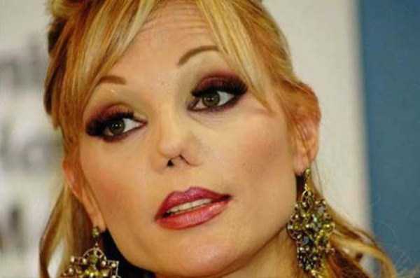 plastic surgery disasters 35