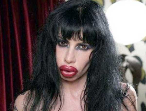 plastic surgery disasters 7