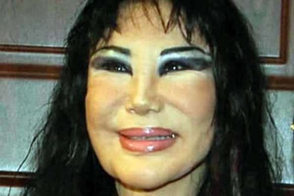 plastic surgery disasters 8