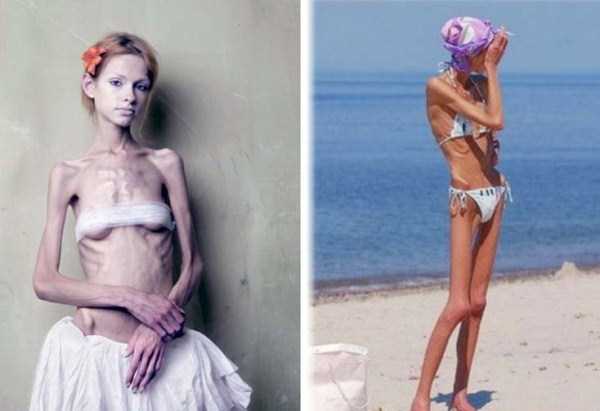 anorexia girls 21