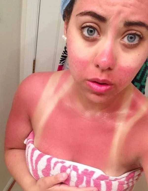 horrible sunburns 1