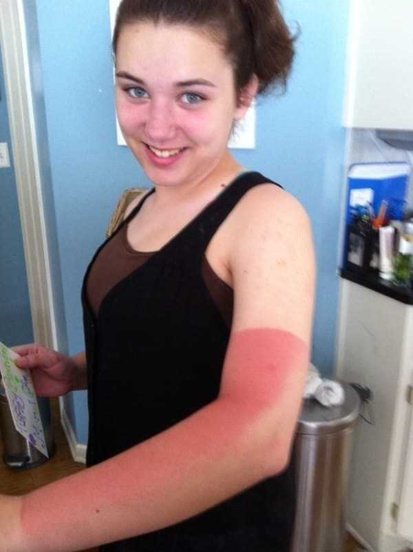 horrible-sunburns (14)