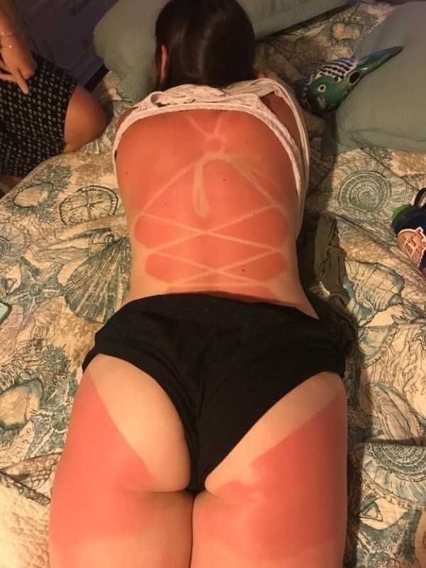 horrible sunburns 2