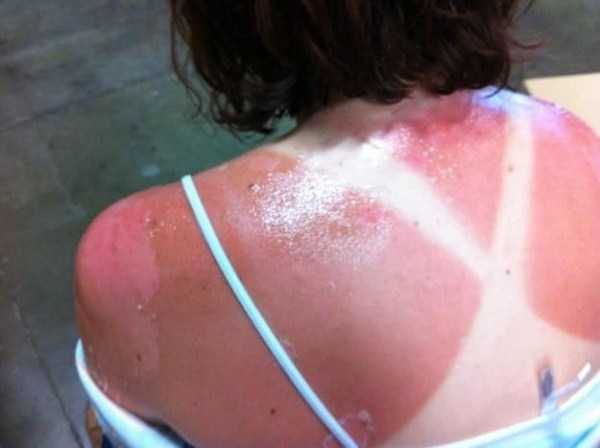 horrible sunburns 20