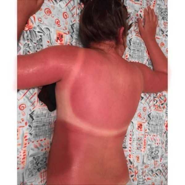horrible sunburns 21