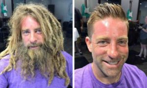 30 People Before And After Plastic Surgery KLYKER.COM