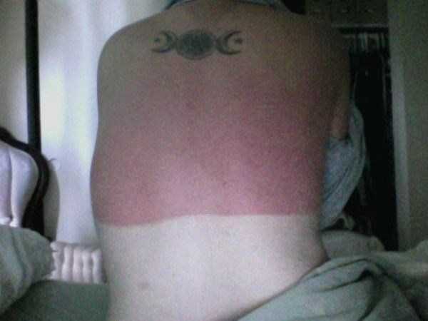 severe sunburns 16 600x450