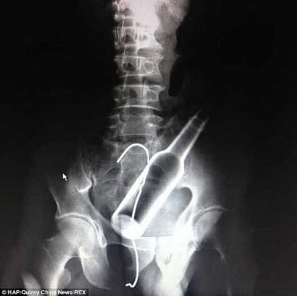 22 WTF Things Found On X Rays (22 photos)