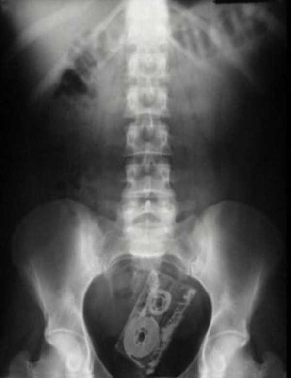wtf xray 9 22 WTF Things Found On X Rays (22 photos)