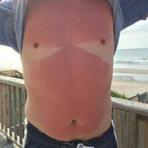 severe sunburns 11