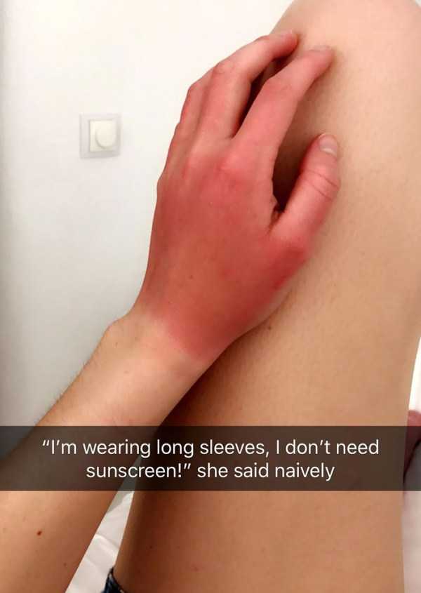 severe sunburns 21