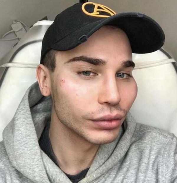 26 Plastic Surgery Catastrophes (26 photos)