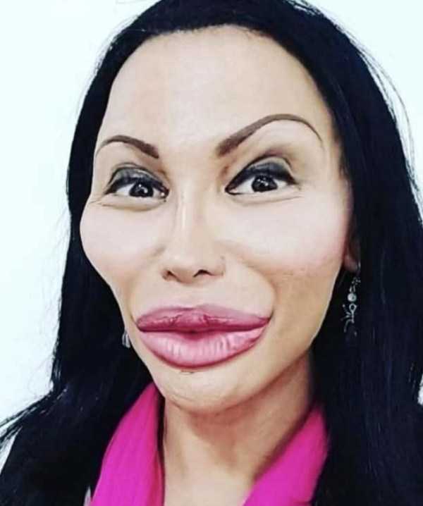 26 Plastic Surgery Catastrophes (26 photos)