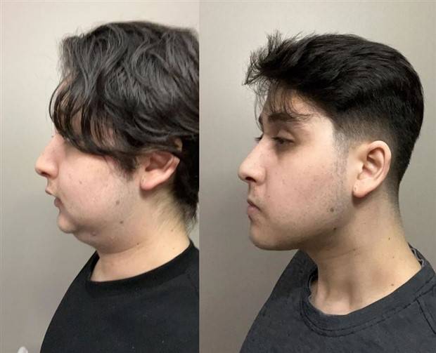 people before after plastic surgery 20 30 People Before And After Plastic Surgery (30 photos)