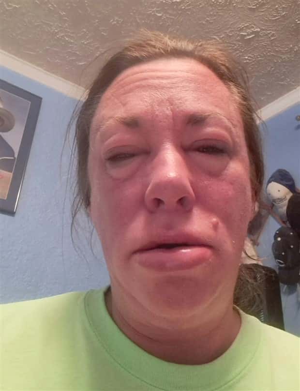 People with Severely Swollen Faces from Allergies (39 photos)