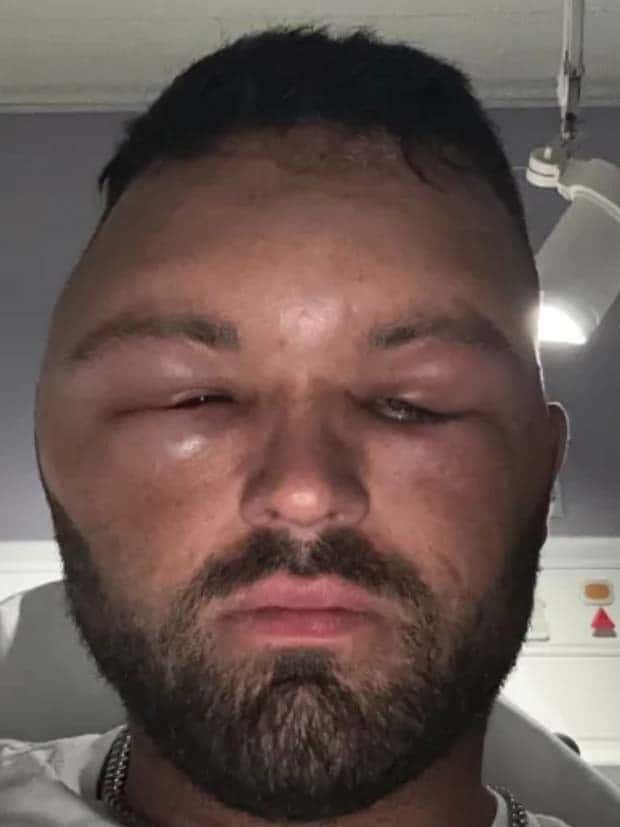 People with Severely Swollen Faces from Allergies (39 photos)