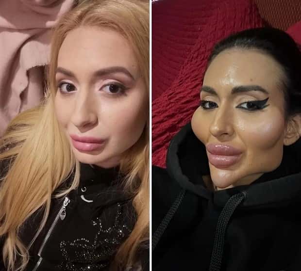 Unfortunate Cosmetic Enhancement Failures (31 photos)