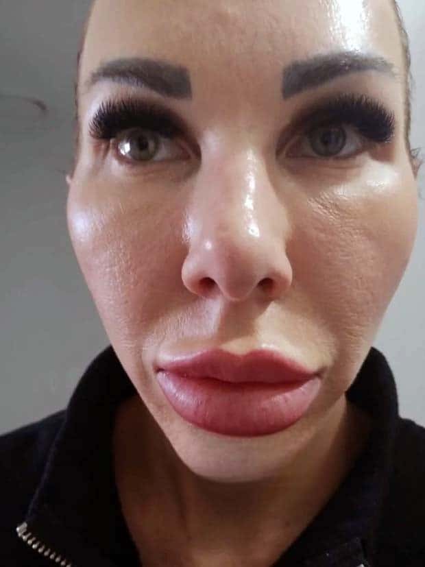 Unfortunate Cosmetic Enhancement Failures (31 photos)