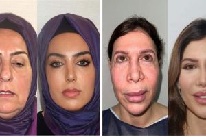 23 Insane Plastic Surgery Face Transformations (23 photos)