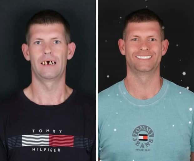 best dental implants 11 Proper Dental Implants Can Transform Any Face (20 photos)