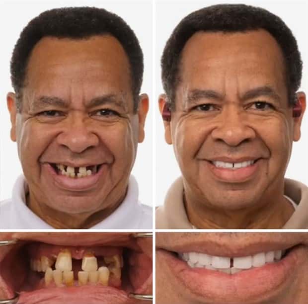 best dental implants 13 Proper Dental Implants Can Transform Any Face (20 photos)