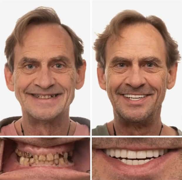 best dental implants 15 Proper Dental Implants Can Transform Any Face (20 photos)
