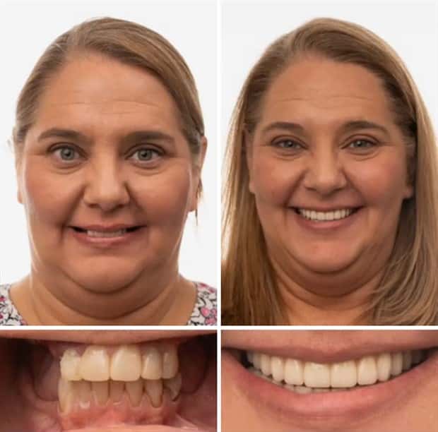 best dental implants 16 Proper Dental Implants Can Transform Any Face (20 photos)