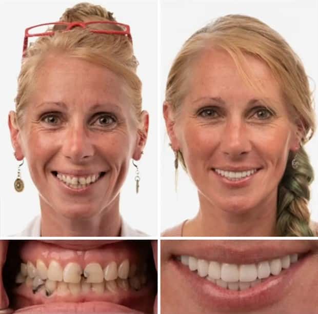 best dental implants 17 Proper Dental Implants Can Transform Any Face (20 photos)
