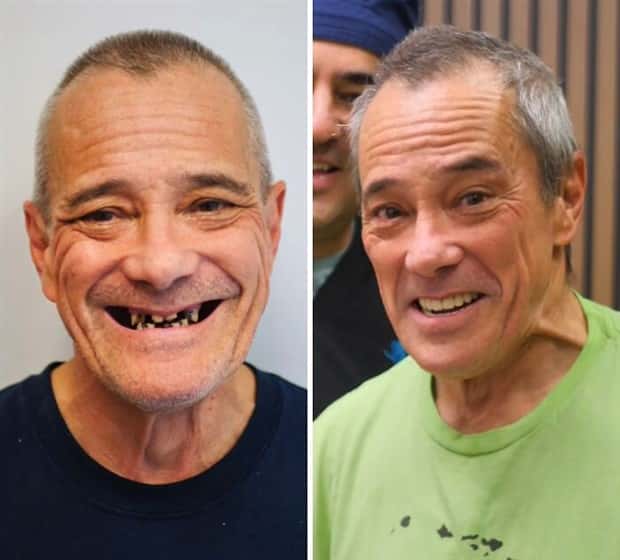 best dental implants 18 Proper Dental Implants Can Transform Any Face (20 photos)