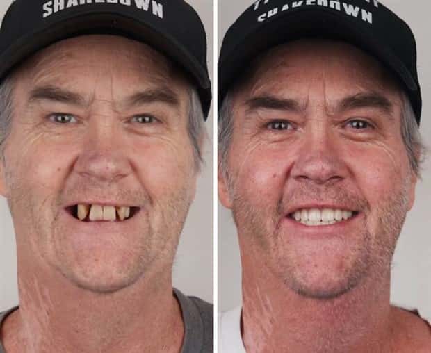 best dental implants 19 Proper Dental Implants Can Transform Any Face (20 photos)