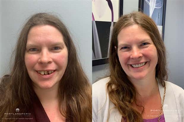 best dental implants 2 Proper Dental Implants Can Transform Any Face (20 photos)