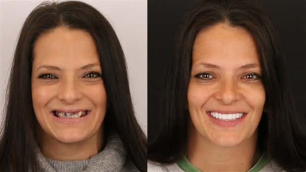 best dental implants 3 Proper Dental Implants Can Transform Any Face (20 photos)