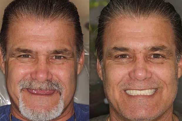 best dental implants 4 Proper Dental Implants Can Transform Any Face (20 photos)