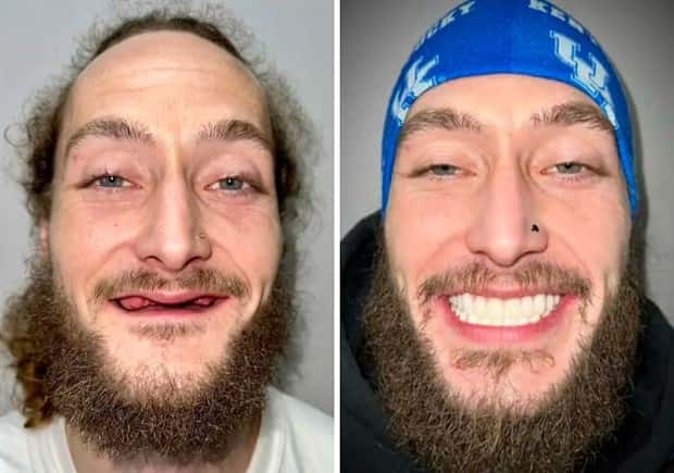 best dental implants 6 Proper Dental Implants Can Transform Any Face (20 photos)