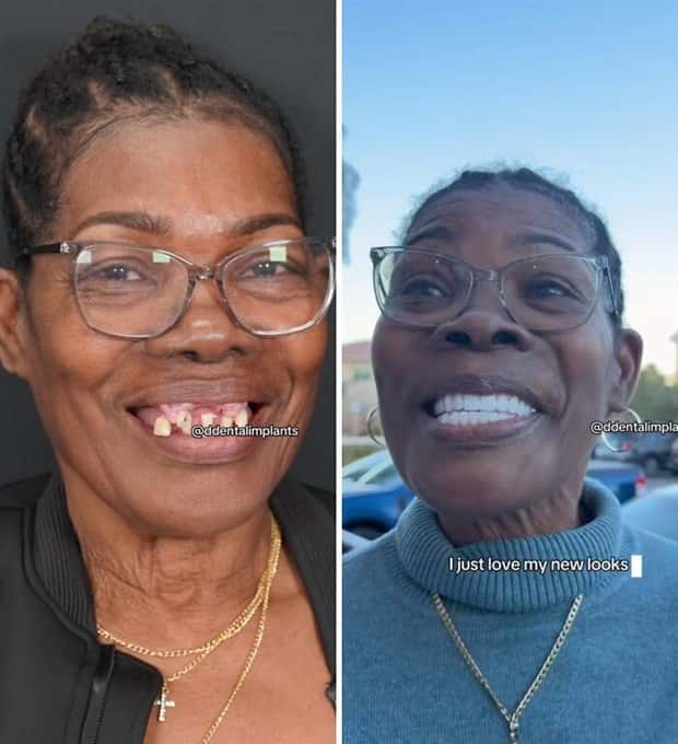 best dental implants 7 Proper Dental Implants Can Transform Any Face (20 photos)