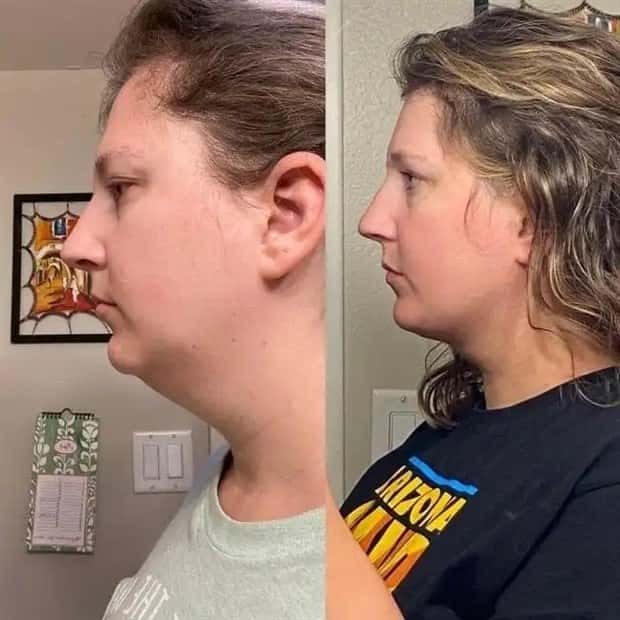 faces after plastic surgery (14)